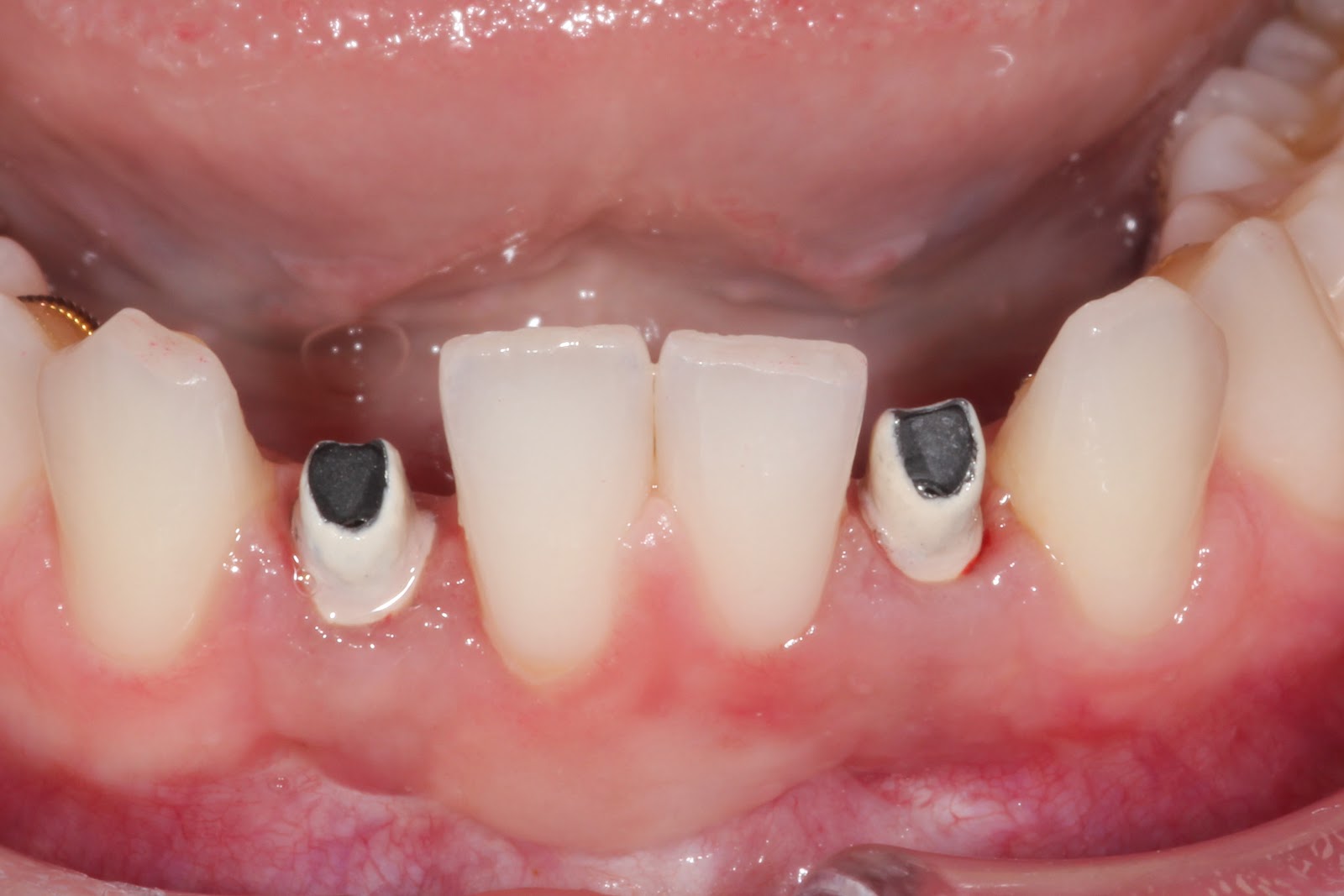 In vitro studies in prosthodontics image
