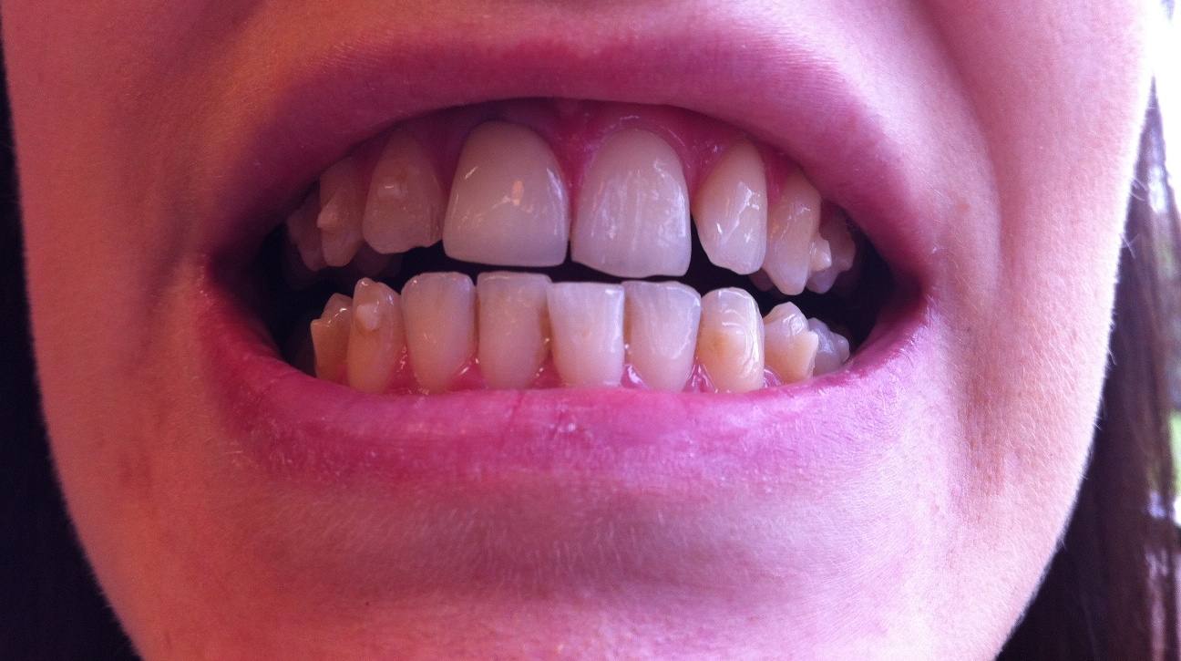 my invisalign April 2012