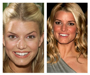 Jessica Simpson Plastic Surgery
