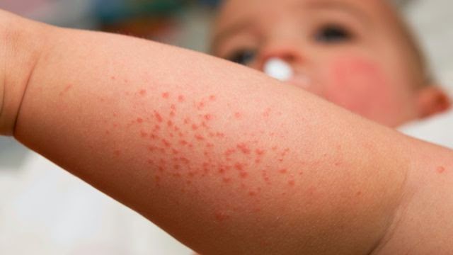 skin allergies image gallery skin allergy skin allergies image gallery skin allergy