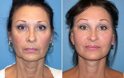Hypostases sob prevenção de olhos