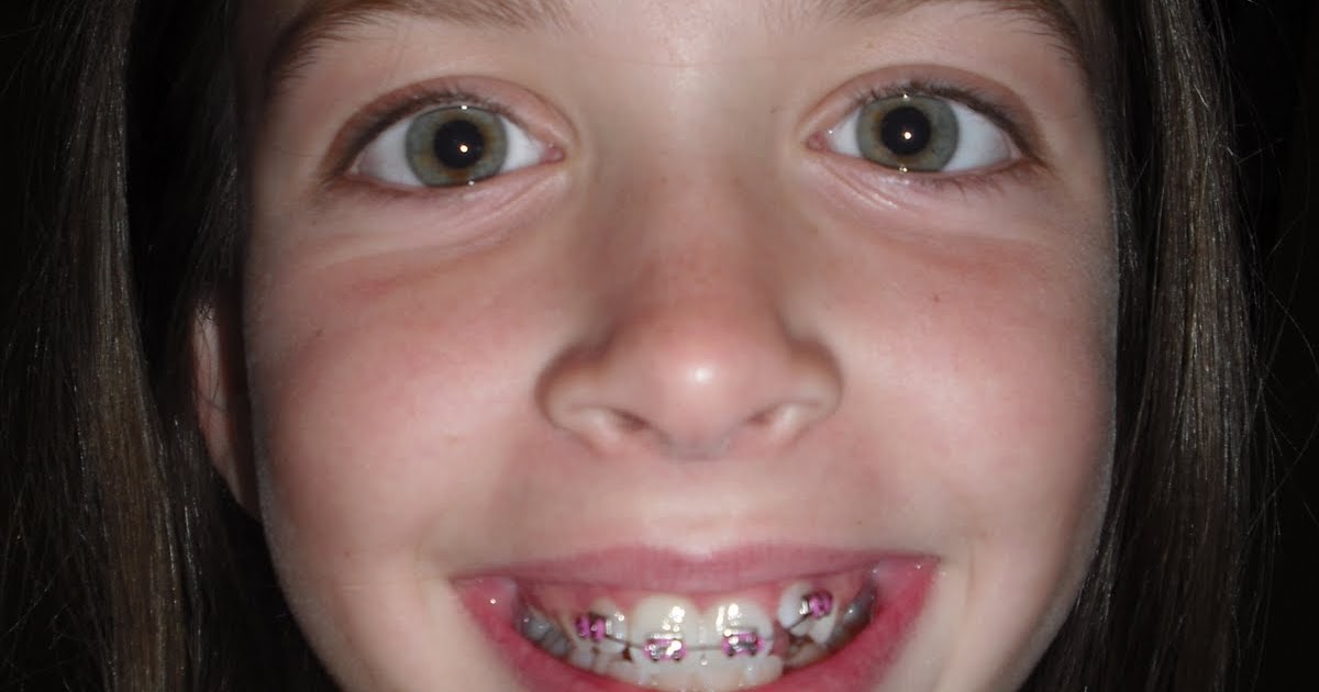 a day at a time brace face!