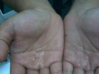 Penyebab Dan Cara Menghilangkan Keringat Berlebihan Di Telapak Tangan Dan Kaki Penyebab Dan Cara Menghilangkan Keringat Berlebihan Di Telapak Tangan Dan Kaki