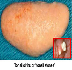 Giant Tonsilloliths Pictures : Cure Of Bad Breath