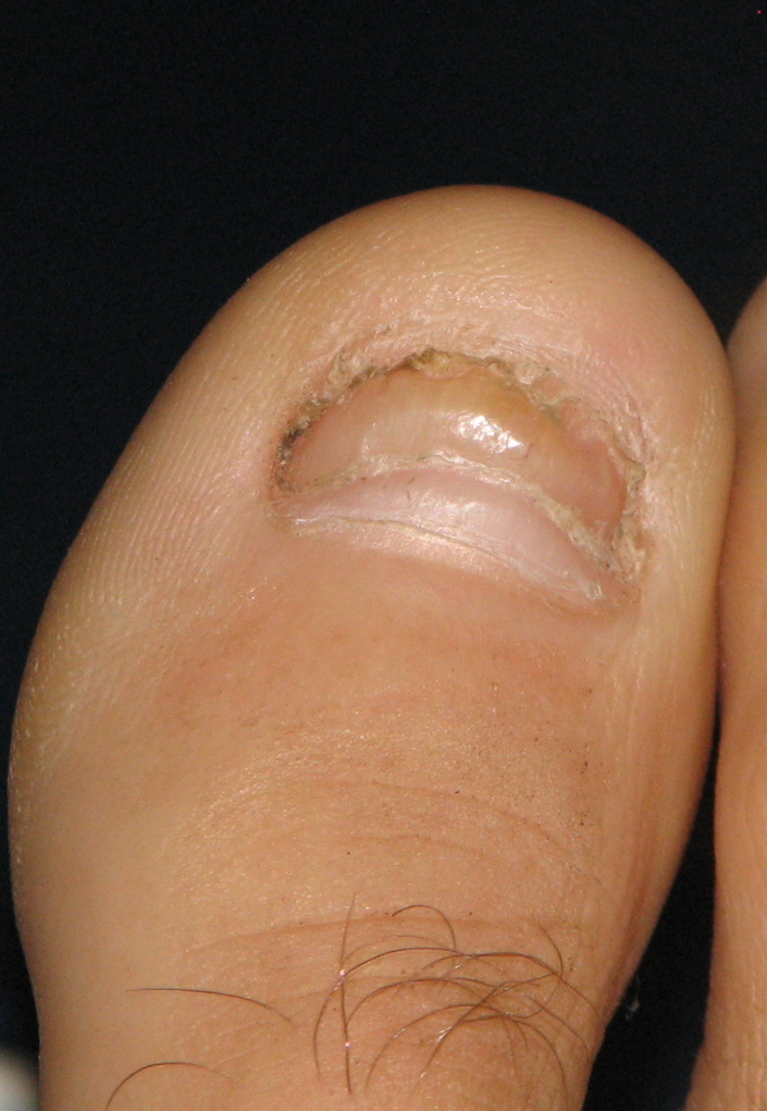 How Long Does It Take A Toenail To Grow Back After Removal at Connie Hammonds blog