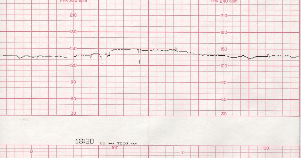 Our first baby Baby's Heartbeat