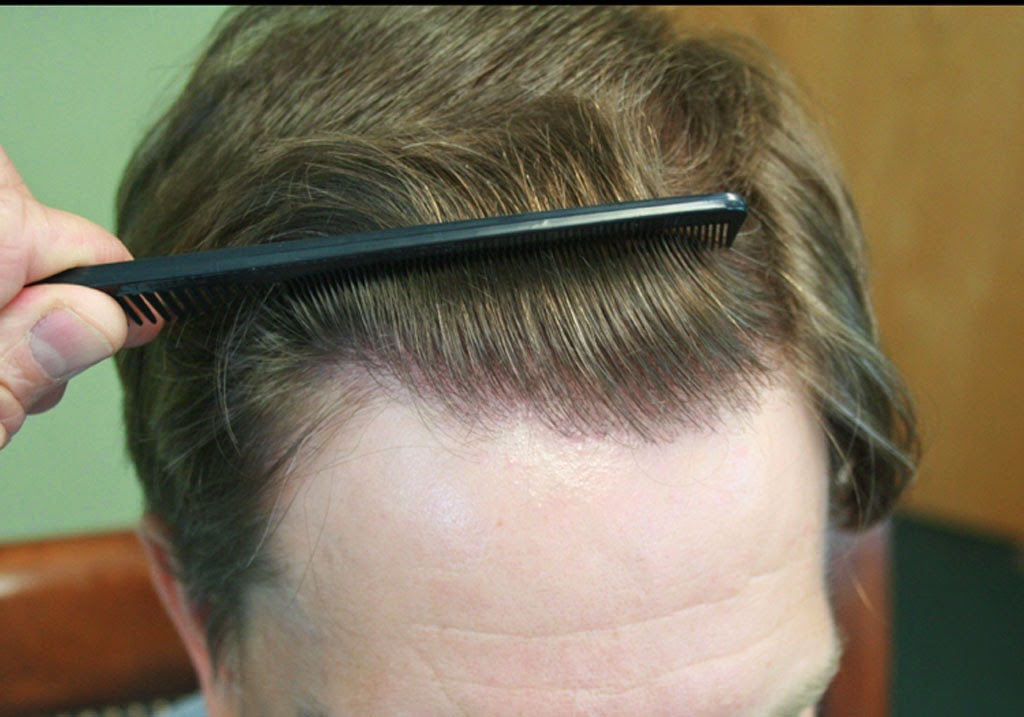 Diffuse Thinning Through Out The Top Diffuse Thinning Through Out Top