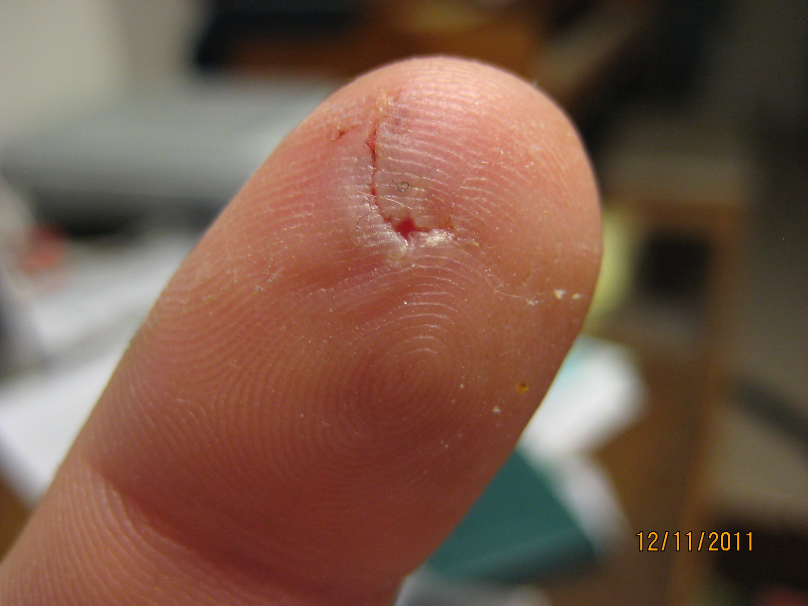 ...high-speed Philips bit into my left index finger. 