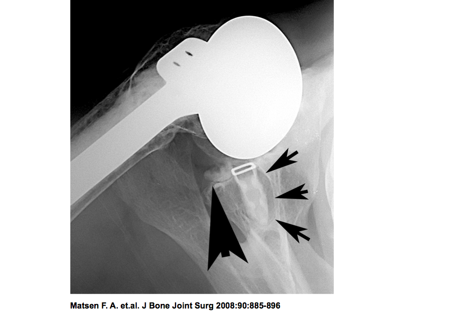 Shoulder Arthritis / Rotator Cuff Tears causes of shoulder pain Total