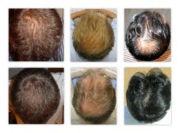 Hair Loss Remedies