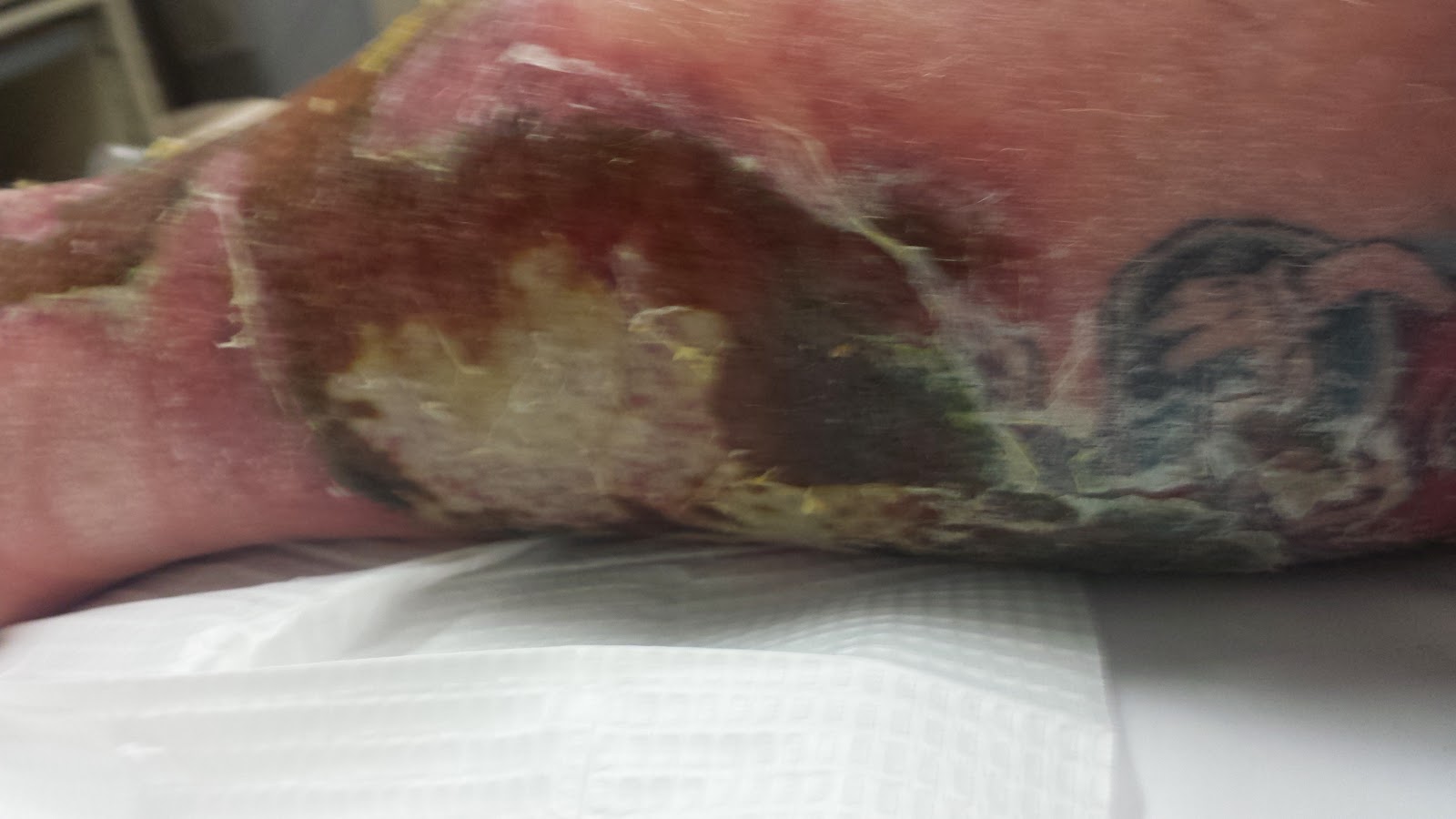 cellulitis warning changes ramblings bandage