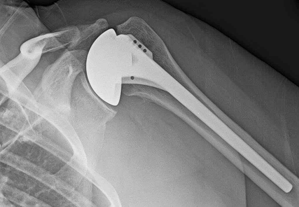 Shoulder and Elbow Surgery Shoulder resurfacing, hemiarthroplasty or
