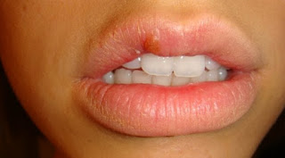 Herpes Labial Remedios Caseros Herpes Labial Remedios Caseros