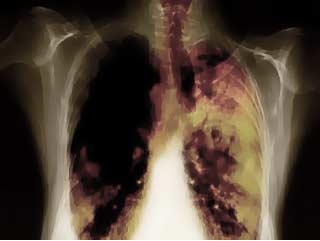 lung cancer herbal treatment