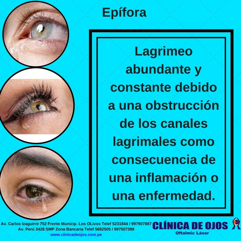 Clínica de Ojos Oftalmic Láser Epífora