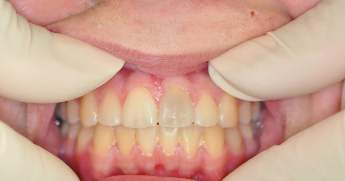 The Endo Blog Calcific Metamorphosis (Pulpal Obliteration) and