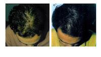 hot-oil-treatment-for-hair