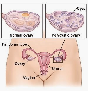 PCOS