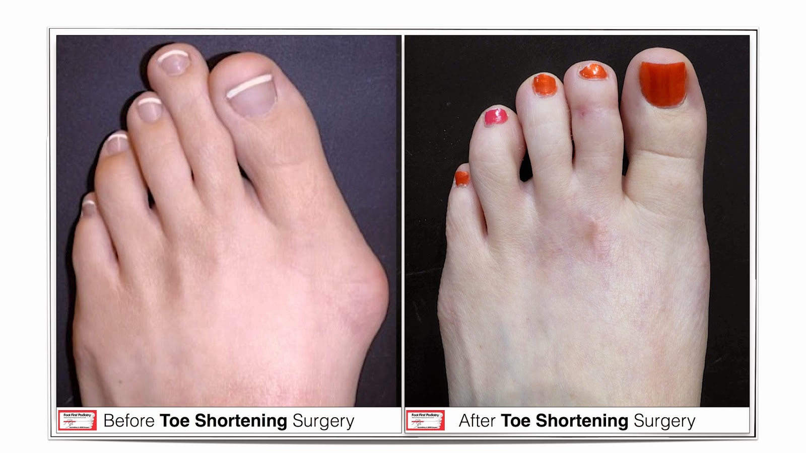Toe Shortening Procedure Long Ugly Toes Foot First Can Give You a