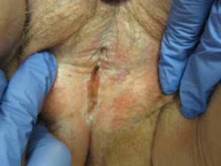 Steroid cause of skin atrophy