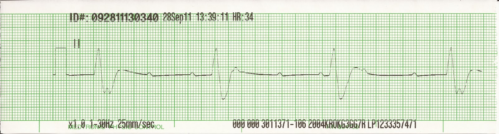 wide complex ivcd wide complex ivcd