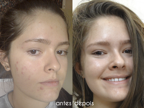 Causas de comedones e foto