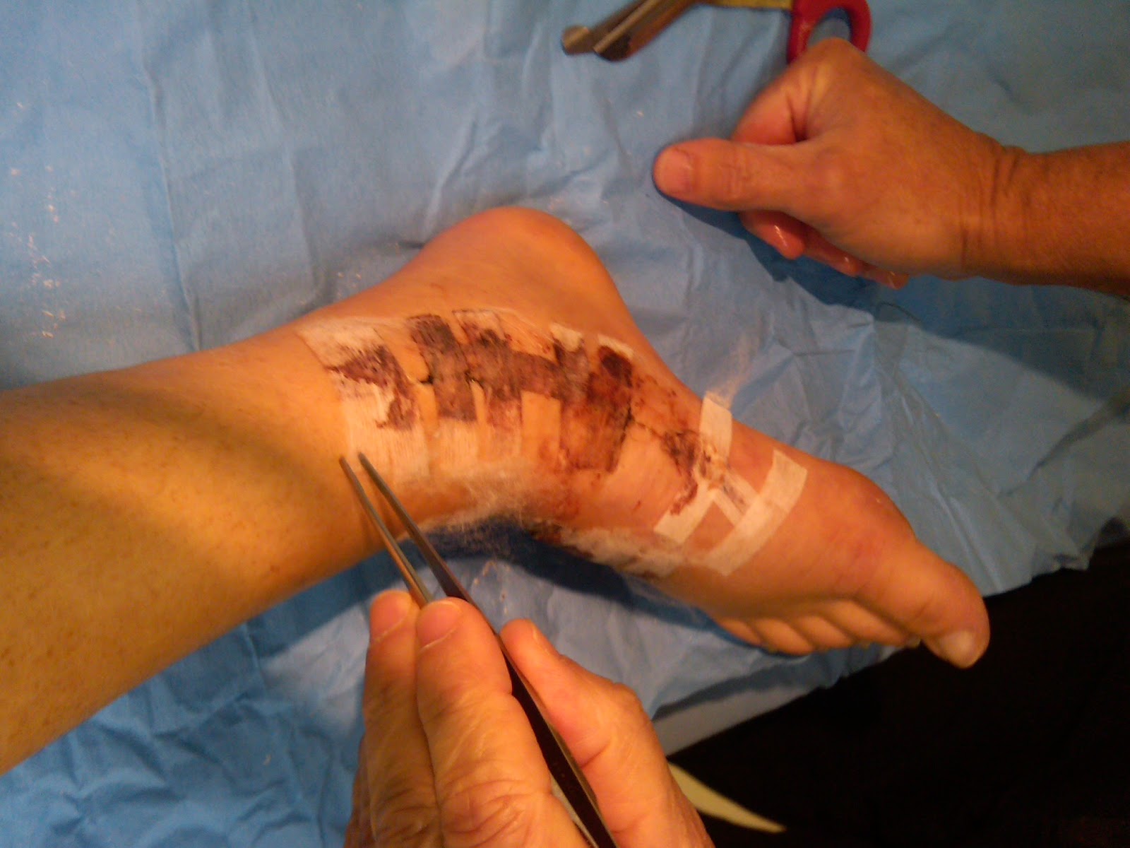 Navicular Diaries