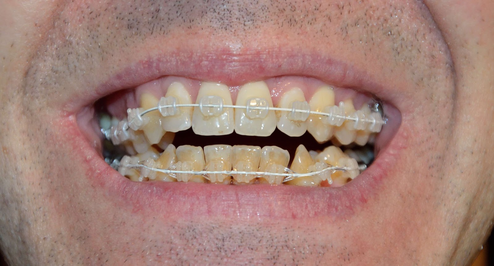 orthodontic treatment teeth adjustment second pull extraction lower soapbox gaps march