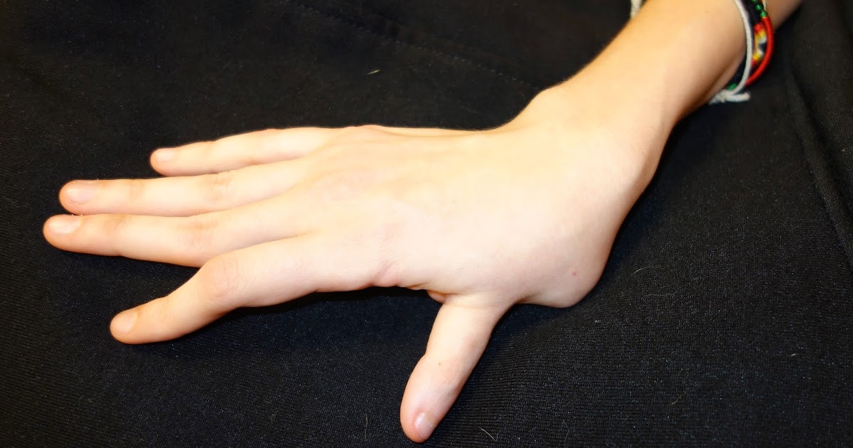 Thumb Deformity in Untreated Thumb Hypoplasia | Congenital Hand and Arm