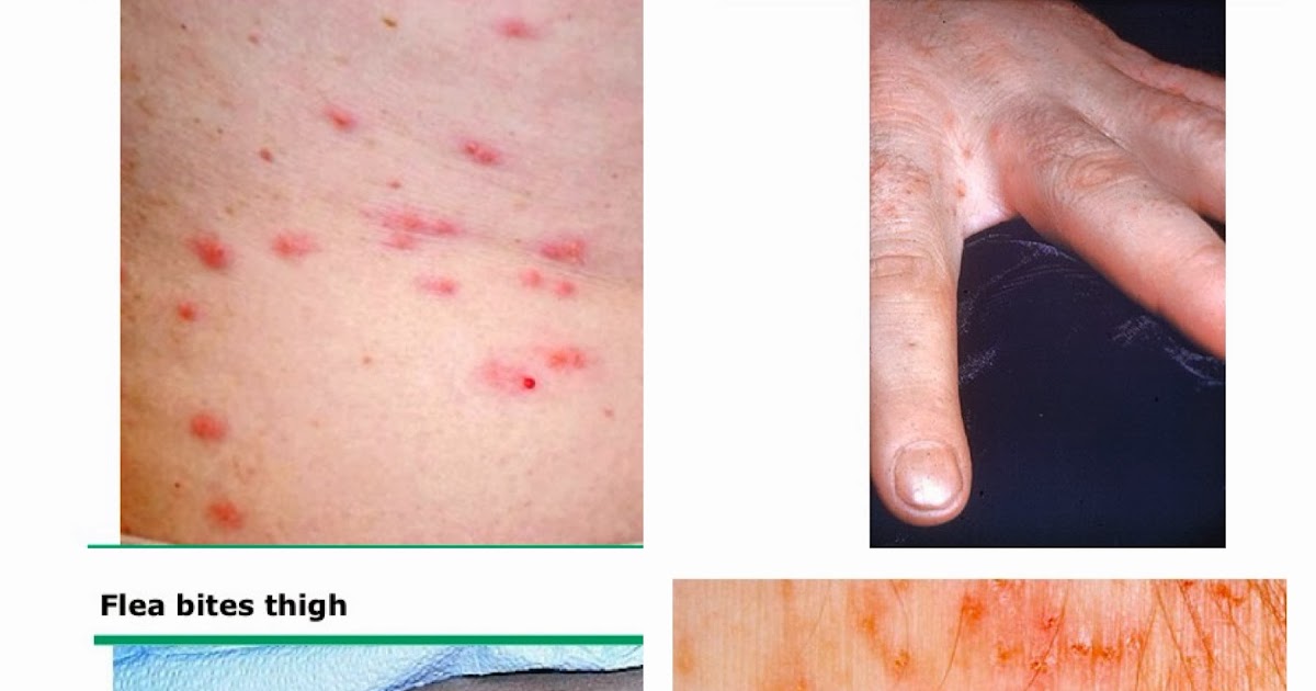 Bed Bath And Beyond Scabies Bed Bath And Beyond Scabies