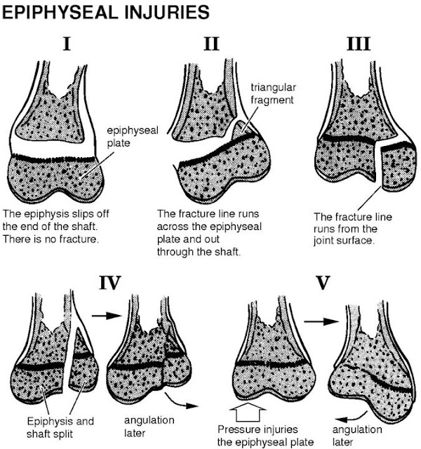 MedicoNotebook Epiphyseal injuries