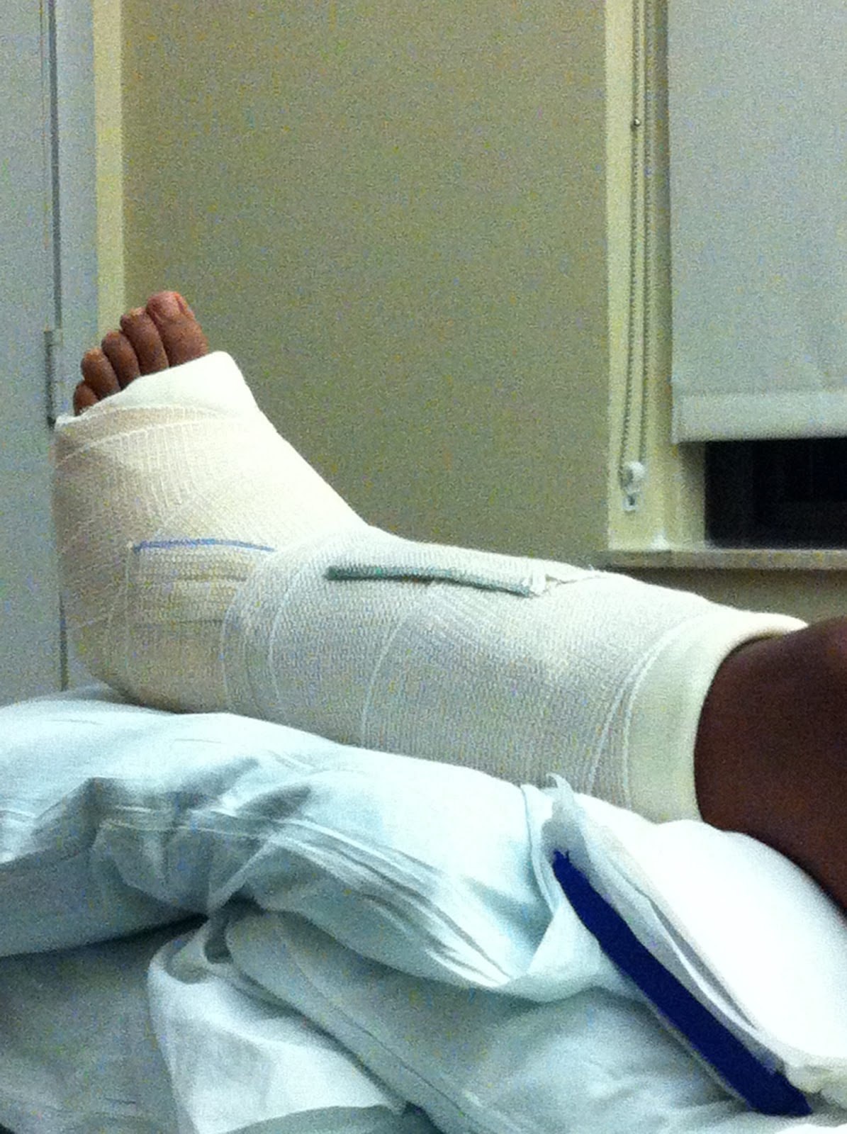 A Runner's Life REDEFINED Surgery Procedure Details and Soft Cast Photo