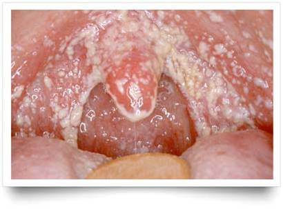 ENFERMEDAD TRANSMISION SEXUAL CAUSADAS HONGO enfermedad transmision sexual causadas hongo: