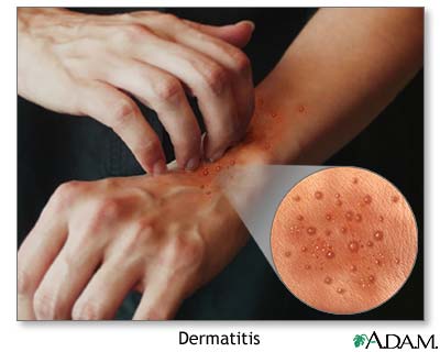 De la psoriasis las manchas rojas sobre el miembro