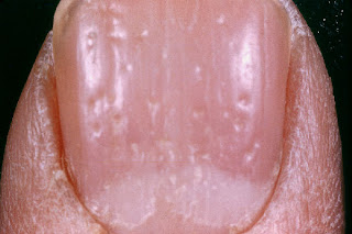 Fingernail nail pitting psoriasis