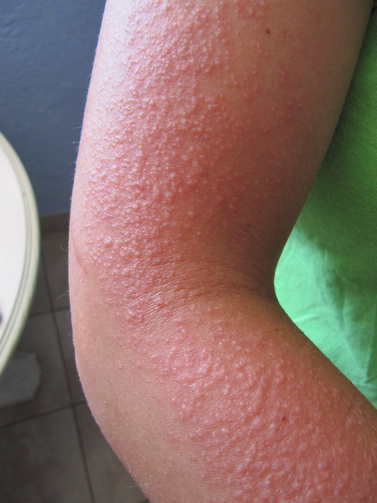 Heat Rash Adults