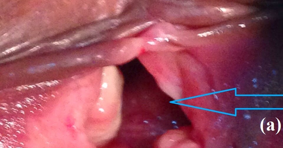Journal Of Postgraduate Gynecology Obstetrics A Case Of Postpartum Pubic Diastasis