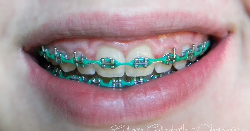 Brace Race (Finally) an update.