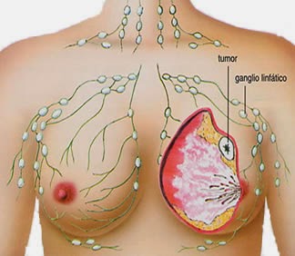 pengobatan tumor payudara tradisional, obat kanker payudara, pengobatan kanker payudara
