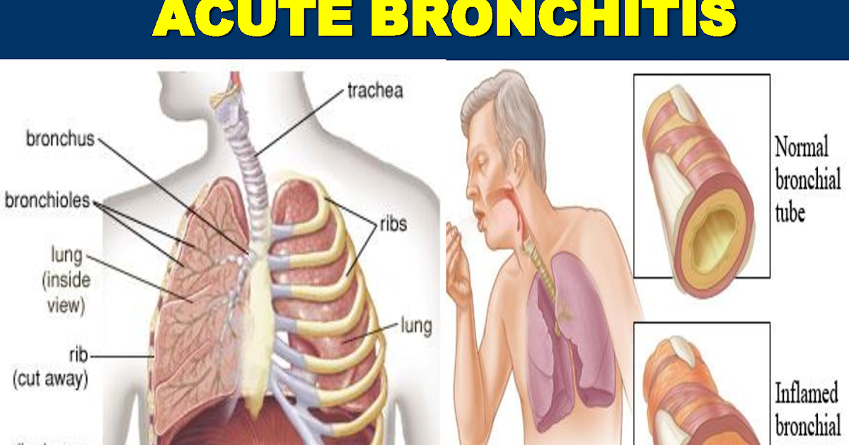 Acute Bronchitis and its Causes Apna Hakeem