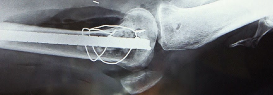 Cirugía de Rescate Articular en Tumores óseos
