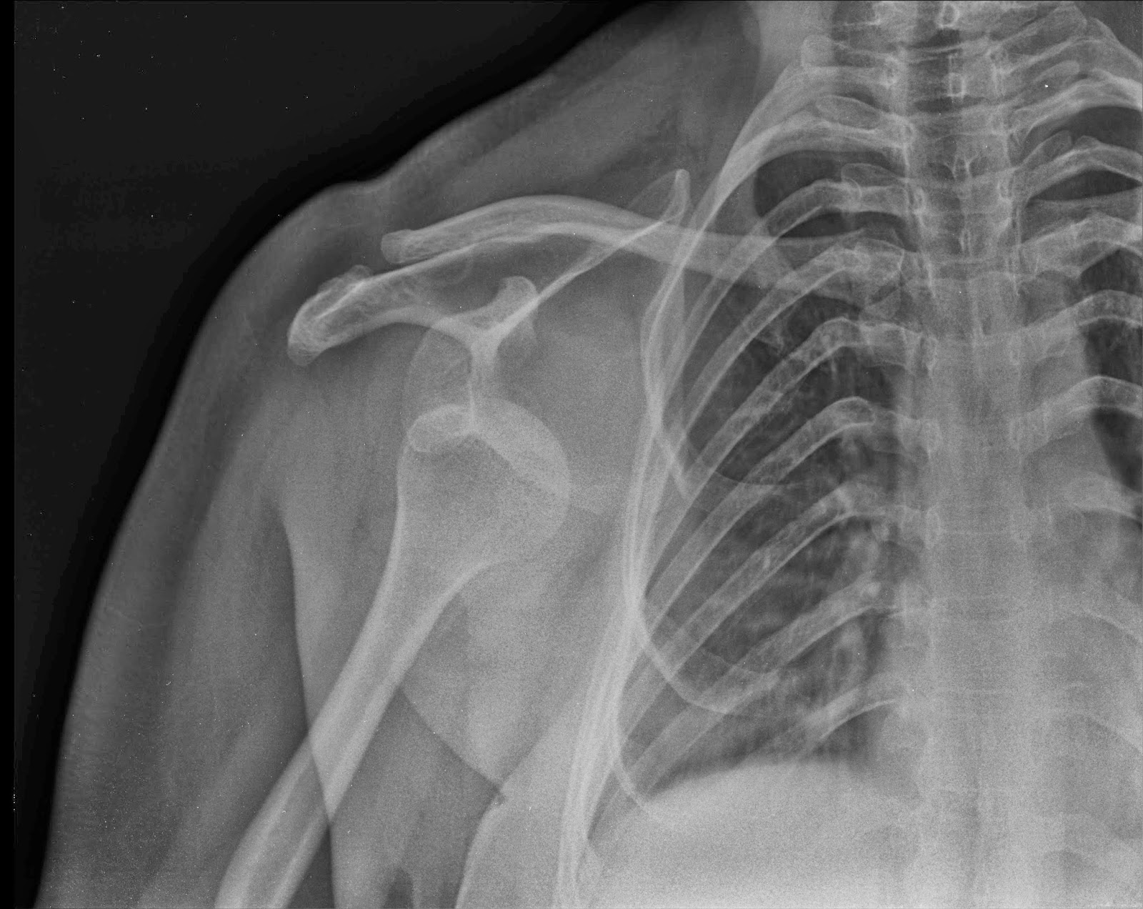 Anterior Shoulder Dislocation Axillary View Anatomy Picture Reference
