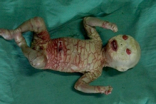Image result for harlequin ichthyosis baby