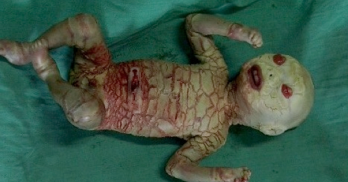 Harlequin ichthyosis or Harlequin baby ~ Dr Impo