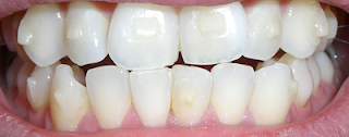 invisalign attachments