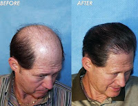 implant par