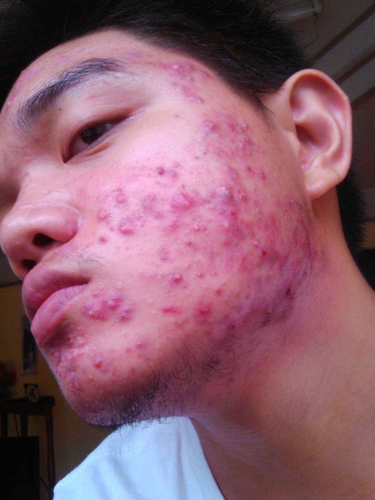 My Journey to being Acnefree End of Week 1 Epiduo