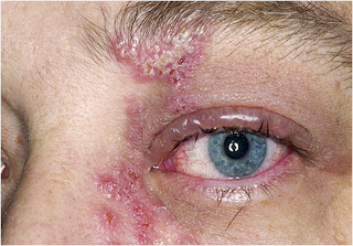 MBBS Medicine (Humanity First): VIRAL INFECTIONS OF THE SKIN