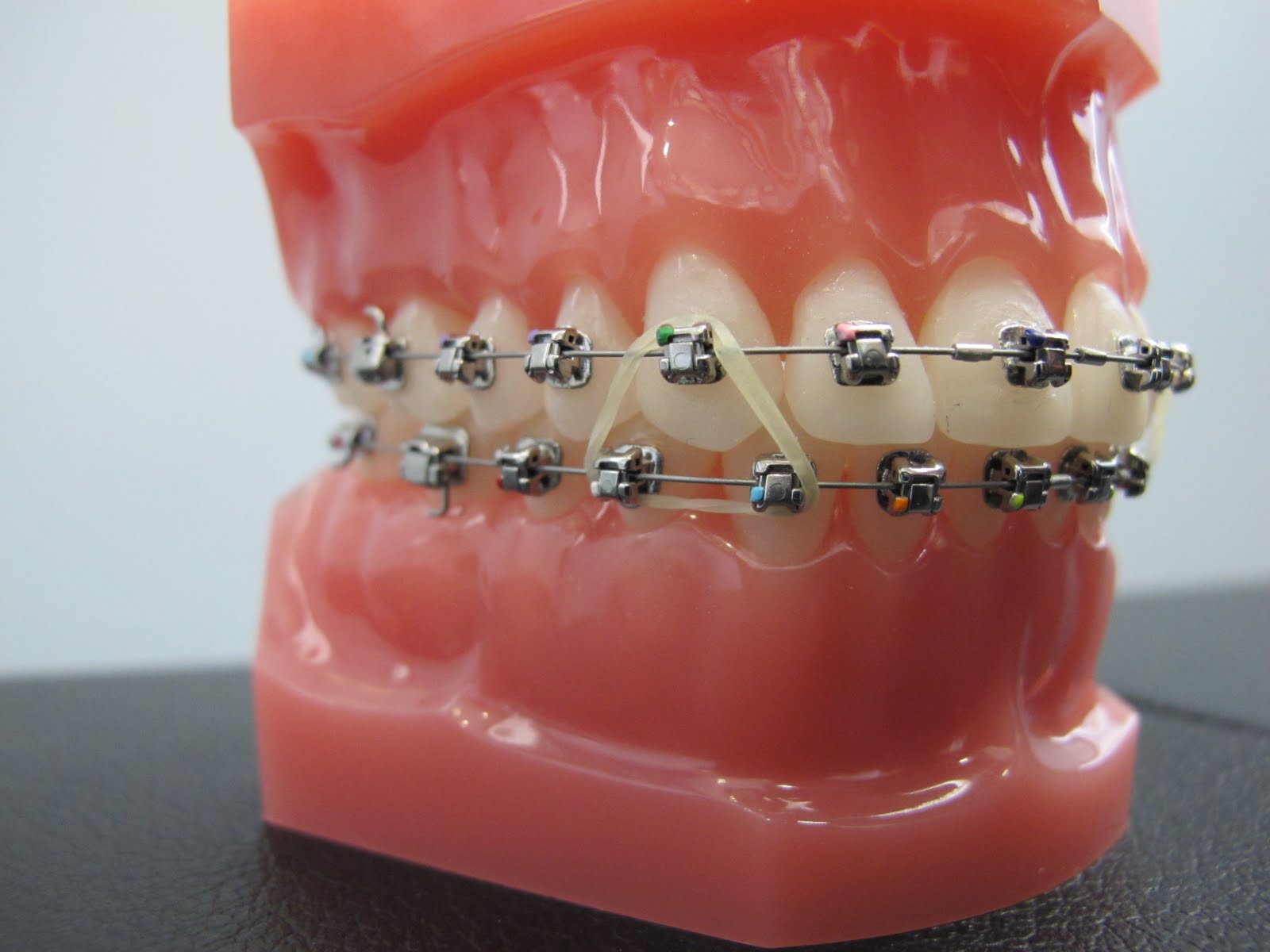 why does bands rubber elastics wearing braces triangle teeth orthodontics recommend dr brackets