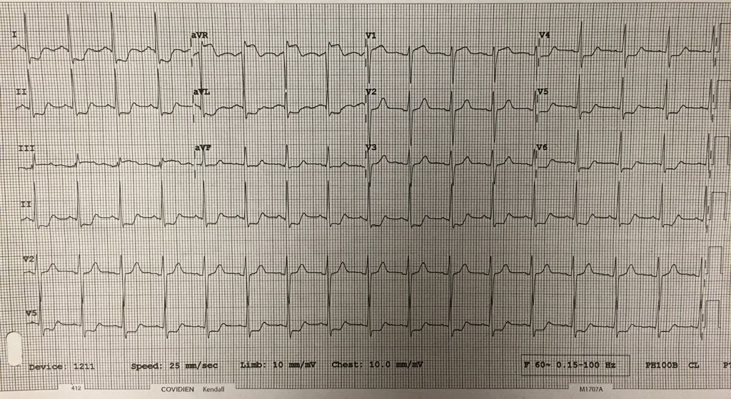 Dr. Smith's ECG Blog Interesting Left Main Occlusion....